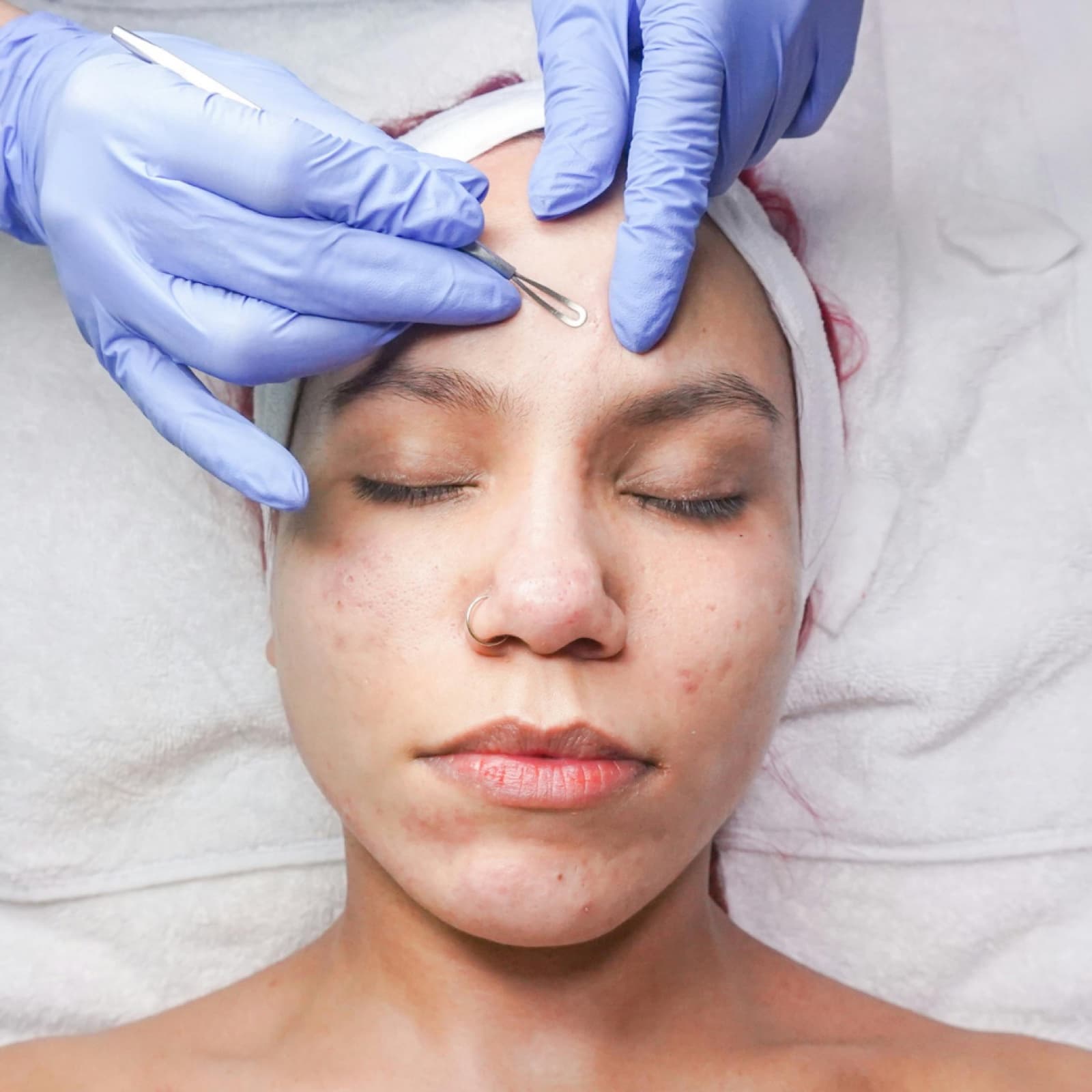 Protocolo facial para piel con tendencia acneica en el centro de Irene Ortiz
