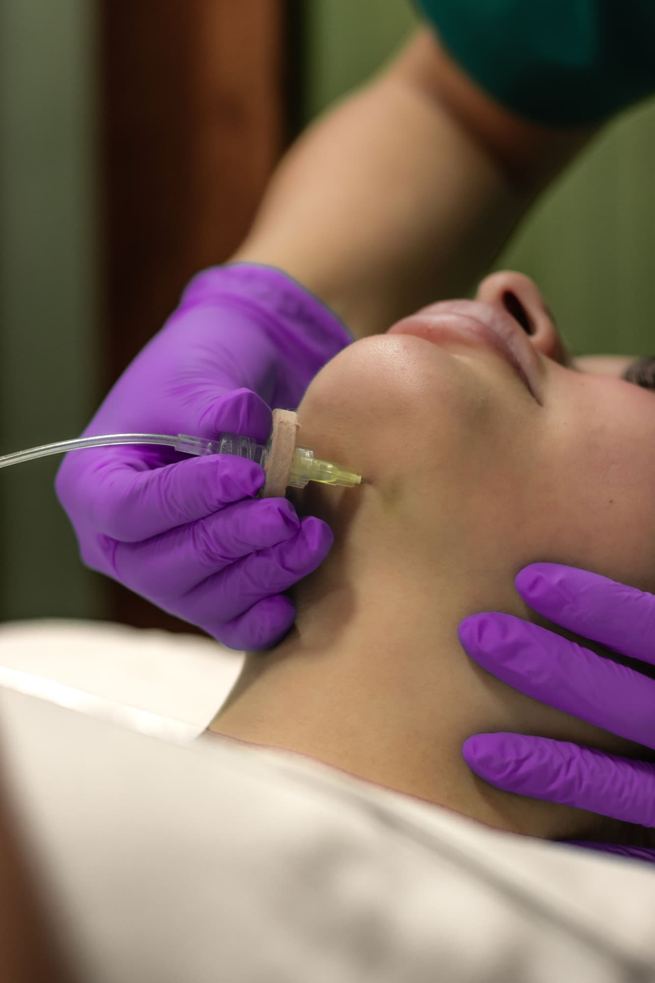 Aplicación de protocolo de mesoterapia en el centro de Irene Ortiz en Cuenca